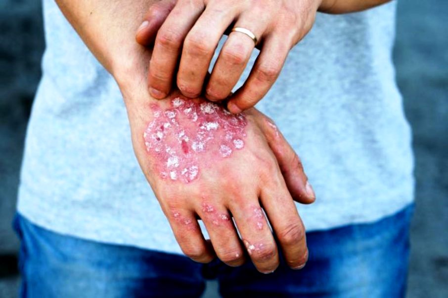 Rating of the best psoriasis remedies for 2020